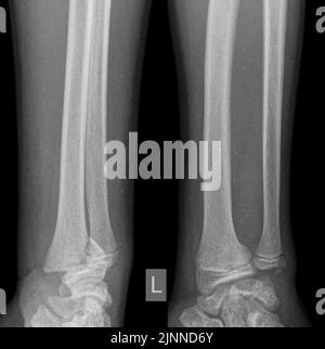 X Ray of human hand with broken wrist, fracture of radius, xray ...