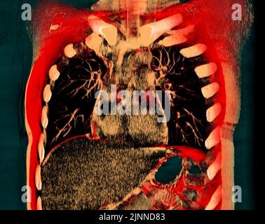 Healthy lungs, 3D CT scan Stock Photo