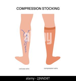 Compression stockings for varicose veins, illustration Stock Photo