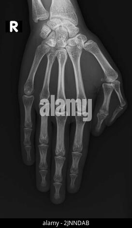 Hand polydactyly, X-ray Stock Photo