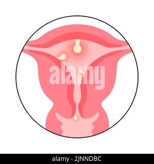 Uterine polyps, illustration Stock Photo