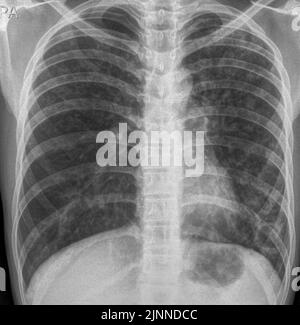 Lung abscess, X-ray Stock Photo - Alamy