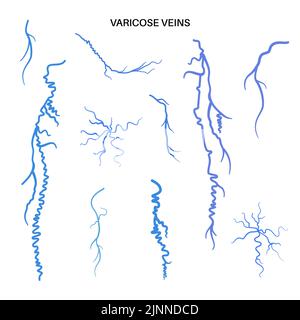 Varicose veins, illustration Stock Photo - Alamy