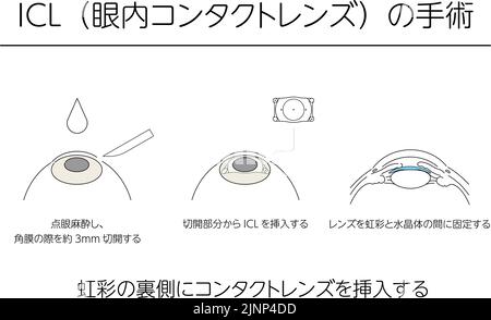 Illustration, Correction of vision with ICL (intraocular contact lens), Medical illustration. - Translation: intraocular contact lens (ICL) surgery, i Stock Vector