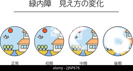 Illustration of glaucoma, changes in visual field as glaucoma ...
