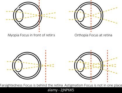 Medical Illustrations Of Vision And Refractive Error, Normal, Myopia ...