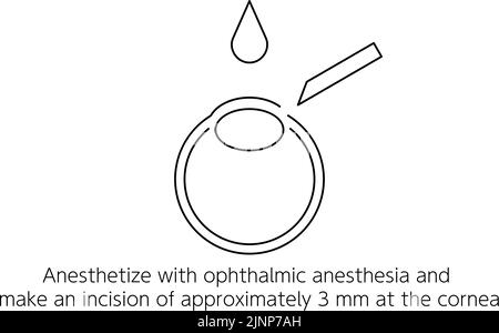 Illustration of ICL (intraocular contact lens) surgery and incision Stock Vector