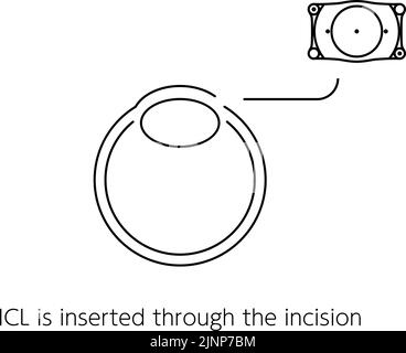 Illustration of ICL (intraocular contact lens) surgery and ICL insertion Stock Vector