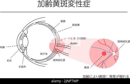 Illustration of eye disease, age-related macular degeneration - Translation: age-related macular abnormalities, cornea, iris, lens, vitreous, retina, Stock Vector
