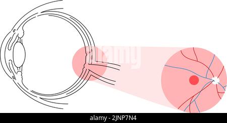 Illustration of eye disease, age-related macular degeneration Stock Vector