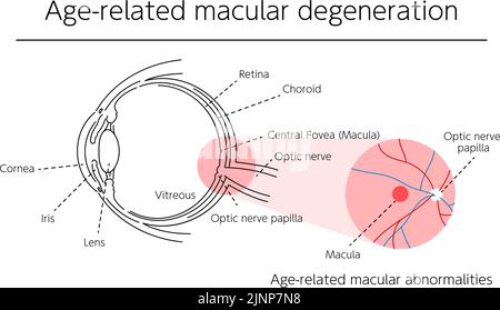 Illustration of eye disease, age-related macular degeneration Stock Vector