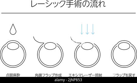 Medical illustration of LASIK and refractive surgery - Translation: LASIK surgery flow, eye drop anesthesia, corneal flap creation, excimer laser irra Stock Vector