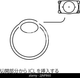 Illustration of ICL (intraocular contact lens) surgery and ICL insertion - Translation: Insert ICL through the incision Stock Vector