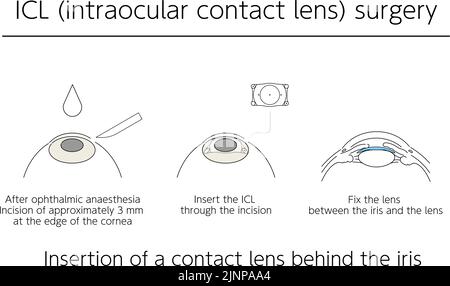 Illustration, Correction of vision with ICL (intraocular contact lens), Medical illustration. Stock Vector