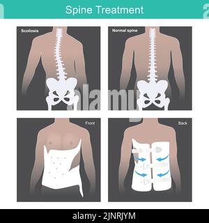 Spine Treatment. He has abnormal spine and after medical usage tool treatment. Illustration anatomy body. Stock Vector