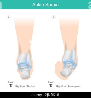 Ankle Bones of Human. Correct position ankle bones of human. Illustration health care. Stock Vector