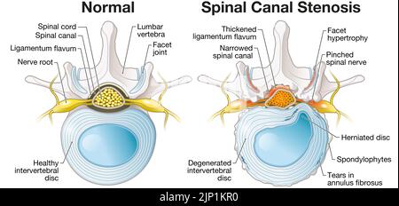 Illustration showing spinal canal stenosis lumbar vertebra with intervertebral disc and herniated nucleus pulposus Stock Photo