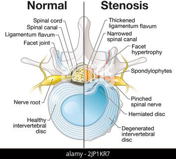 Prolapsed spinal disc, illustration Stock Photo - Alamy