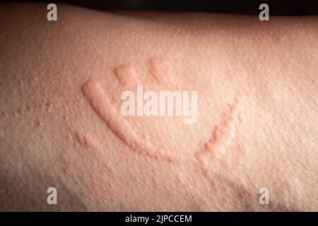 Smiling face hives. Hives spread when you scratch on the skin. Stock Photo