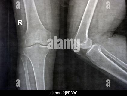 Plain X ray of the right knee shows apparent joint osteoarthritis according to Kellgren and Lawrence system for classification of osteoarthritis with Stock Photo