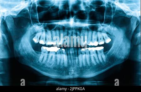 Panoramic dental x-ray image or orthopantomogram of jaw with all teeth ...