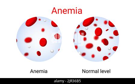 Anemia problem circulatory iron body diagram background. Anaemia biology blood isolated medical normal icon. Stock Vector