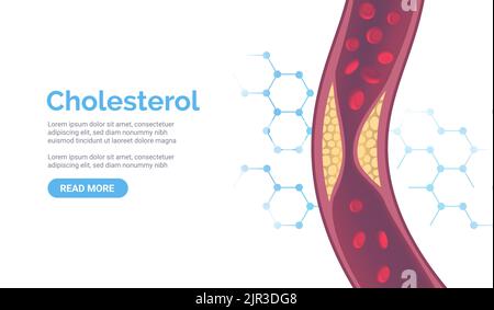 Cholesterol artery thrombosis micro vascular desease. Arteriosclerosis blood vector atherosclerosis risk Stock Vector