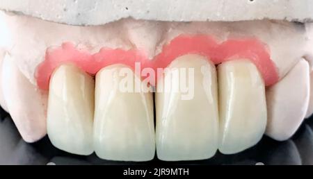 Ceramic dental bridge on plaster model. Dental prosthesis manufacturing workshop. Full wax denture. Selective focus. Dental implant. Restoration of Stock Photo
