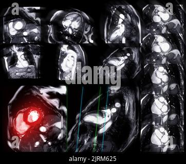 Collection of  MRI heart or Cardiac MRI ( magnetic resonance imaging ) of heart  showing heart beating for detecting heart disease. Stock Photo