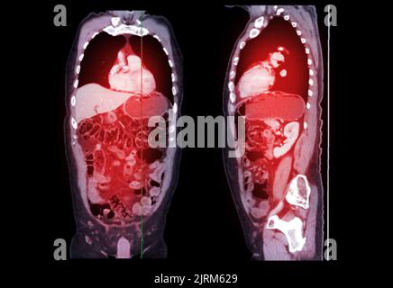 CT SCAN of Chest and Abdomen Coronal and sagittal view with injection contrast media for diagnonsis chest and abdomen disease. Stock Photo