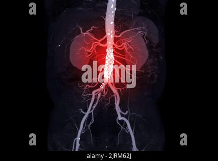 CTA of the abdominal aorta with stent-grafting in patient Abdominal aortic aneurysm. Stock Photo
