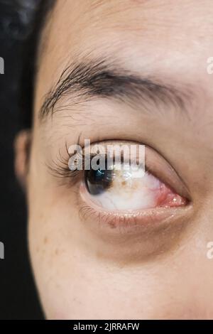 Closeup woman with Brown Spot on her Sclera Diagnosed as Hemorrhagic Conjunctivitis Stock Photo