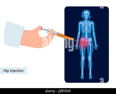 Hip joint injection, illustration Stock Photo