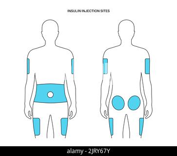 Insulin injection sites, illustration Stock Photo