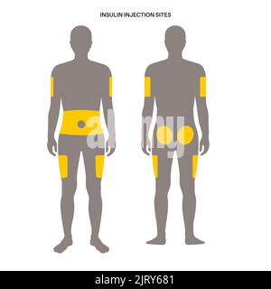 Insulin injection sites, illustration Stock Photo