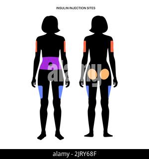 Insulin injection sites, illustration Stock Photo