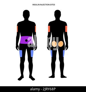 Insulin injection sites, illustration Stock Photo