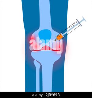 Knee injection, illustration Stock Photo - Alamy