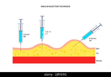 Insulin injection sites, illustration Stock Photo