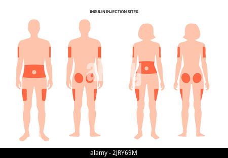 Insulin injection sites, illustration Stock Photo