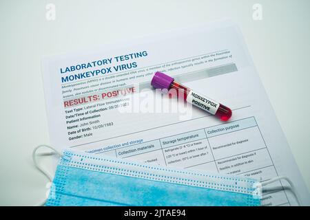 Blood collection tubes monkeypox test positive results Stock Photo - Alamy
