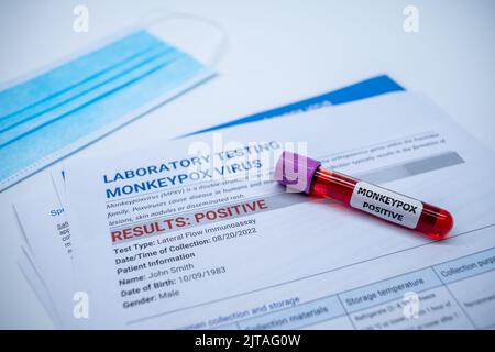 Blood collection tubes and data sheet on monkeypox test positive results in laboratories Stock Photo