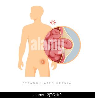 Strangulated Hernia - Section of the Small Intestines - Stock ...