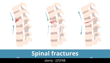 Spinal fractures. Types of spinal fractures depend on damage direction. Fracture of the vertebrae (backbone) caused from injury, trauma, fall, sport Stock Vector