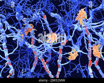 Illustration of damaged nerve cells caused by the degenerative disease multiple sclerosis. Immune system cells (microglia, orange) have attacked the nerve cell sheaths (myelin), resulting in damaged myelin (red) and disturbed signalling function between the nerves cells (neurons, blue). Multiple sclerosis is a progressive disorder that can cause tingling, speech disorders, lack of coordination, paralysis and death. The microglia cells attack the oligodendrocytes that form the insulating myelin sheath around neuron axons, leading to the destruction of the myelin sheath. Stock Photo