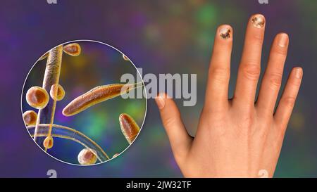 Fungal infection on a man's hand, illustration. Known as ringworm