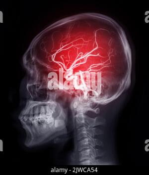 Skull image fusion with MRI MRA Brain  for evaluate them  stenosis  and stroke disease. Stock Photo