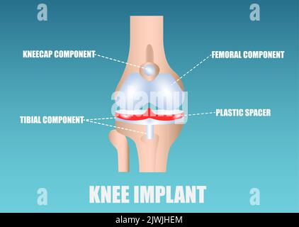 Vector of a human knee implant Stock Vector