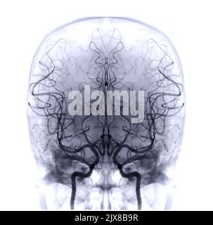 Brain CT scan showing vascular Circle of Willis Stock Photo - Alamy