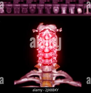 CT SCAN of Cervical Spine ( C-spine ) patient trauma case 3D rendering image . Stock Photo